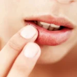7 Cara Mengatasi Bibir Terluka karena Gigi