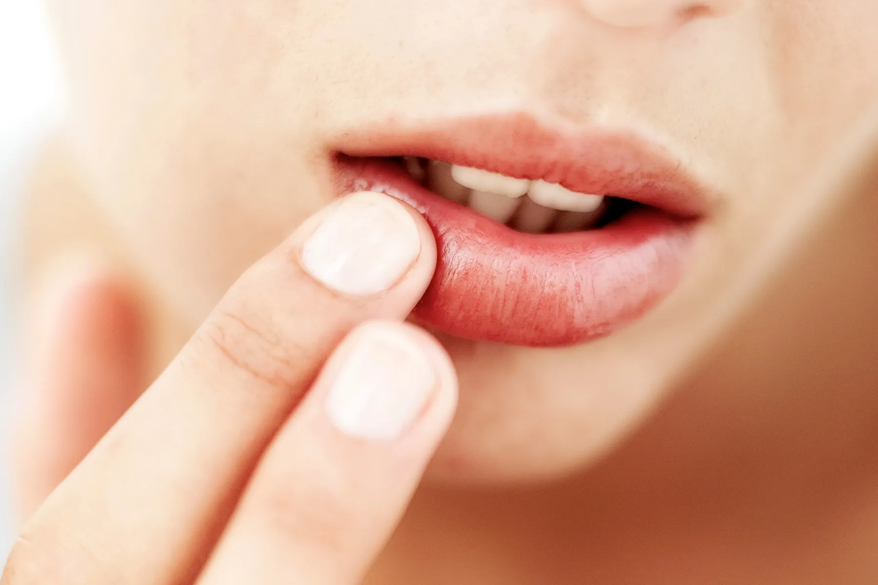 7 Cara Mengatasi Bibir Terluka karena Gigi