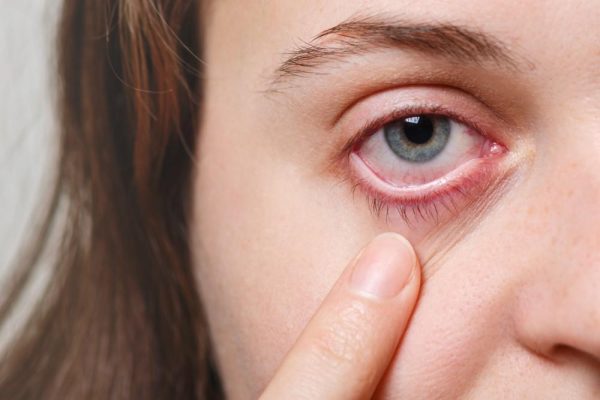 10 Cara Mengurangi Risiko Infeksi Mata