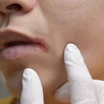 5 Cara Cegah Infeksi di Area Bibir