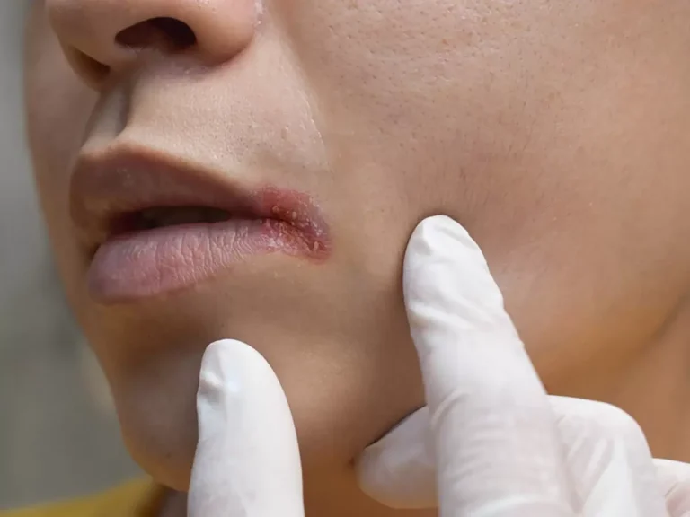 5 Cara Cegah Infeksi di Area Bibir