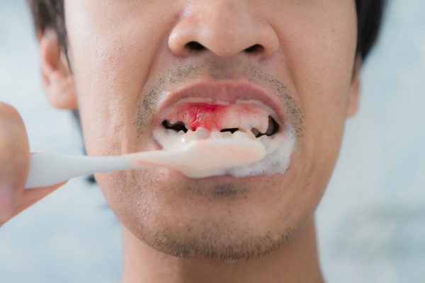 10 Kesalahan Merawat Gigi yang Sering Dilakukan 10 Kesalahan Merawat Gigi yang Sering Dilakukan