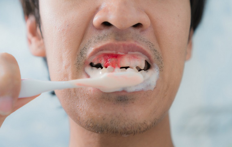 10 Kesalahan Merawat Gigi yang Sering Dilakukan