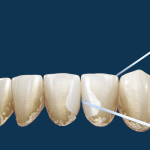 7 Langkah Menghilangkan Sisa Makanan di Gigi Tanpa Sikat