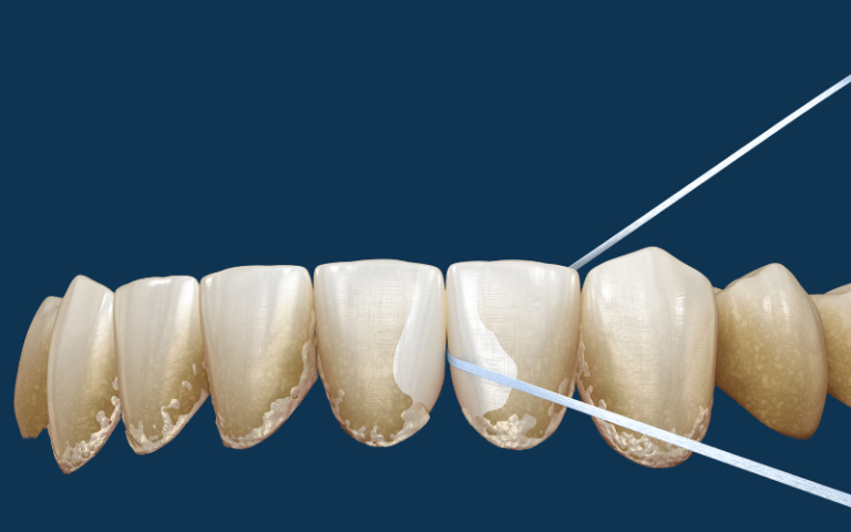 7 Langkah Menghilangkan Sisa Makanan di Gigi Tanpa Sikat