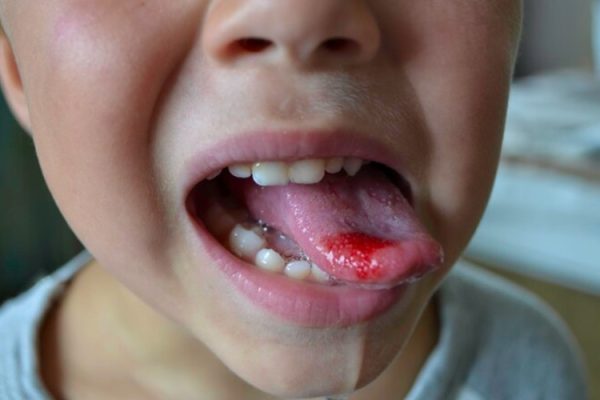 7 Langkah Mencegah Luka di Lidah karena Gigi Tajam
