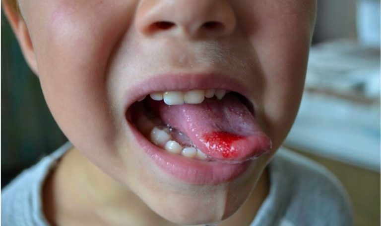 7 Langkah Mencegah Luka di Lidah karena Gigi Tajam