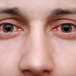 10 Cara Menenangkan Mata yang Terasa Panas dan Pedih