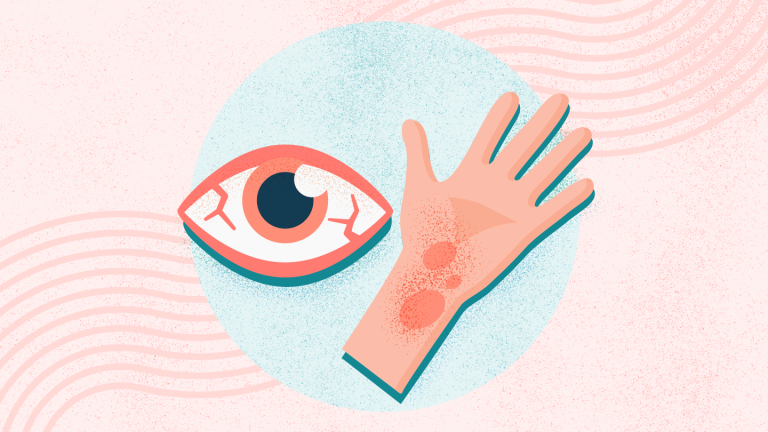 7 Tips Mengatasi Alergi Musiman dengan Pola Hidup Sehat