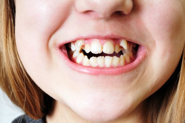 10 Penyebab Gigi Rapuh dan Cara Mencegahnya