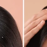 10 Teknik Perawatan Rambut untuk Mengatasi Ketombe Parah