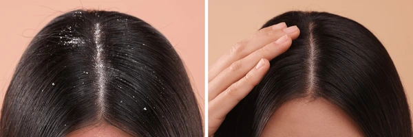 10 Teknik Perawatan Rambut untuk Mengatasi Ketombe Parah